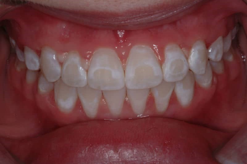 لکه های سفید روی دندان پس از برداشتن براکت ها