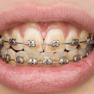 رابطه درمان ارتودنسی و پوسیدگی دندان