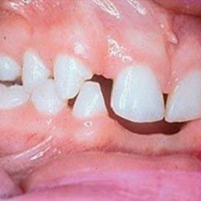 دندان درنیاوردن کودکان و نوزادان