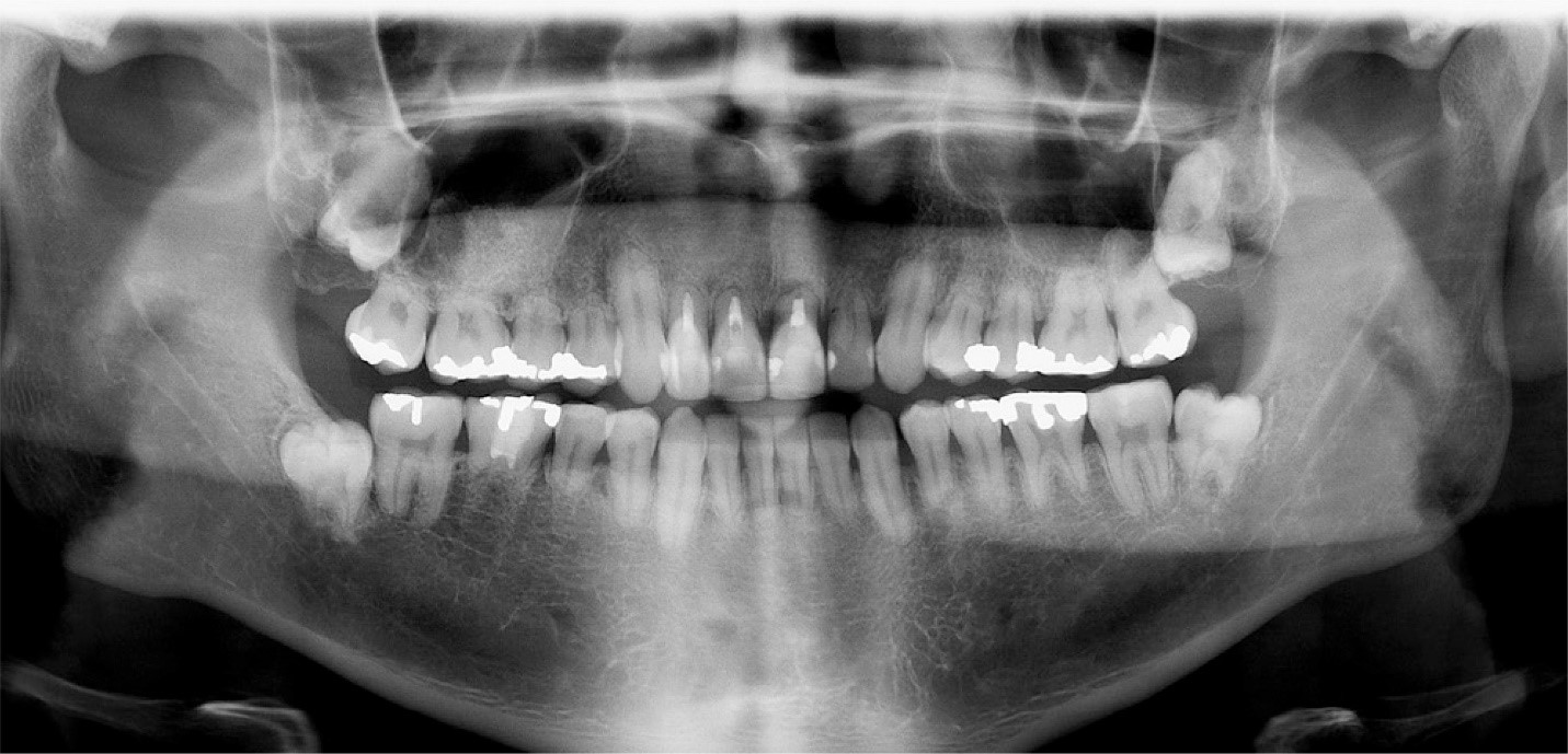 تحلیل ریشه دندان در ارتودنسی
