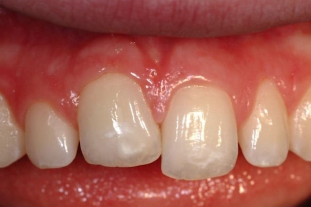 انکیلوز دندان یا جوش خوردن دندان