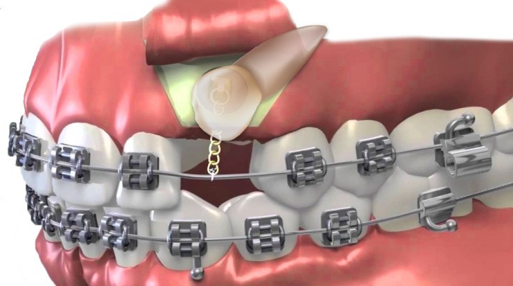 درمان ارتودنسی دندان های نهفته
