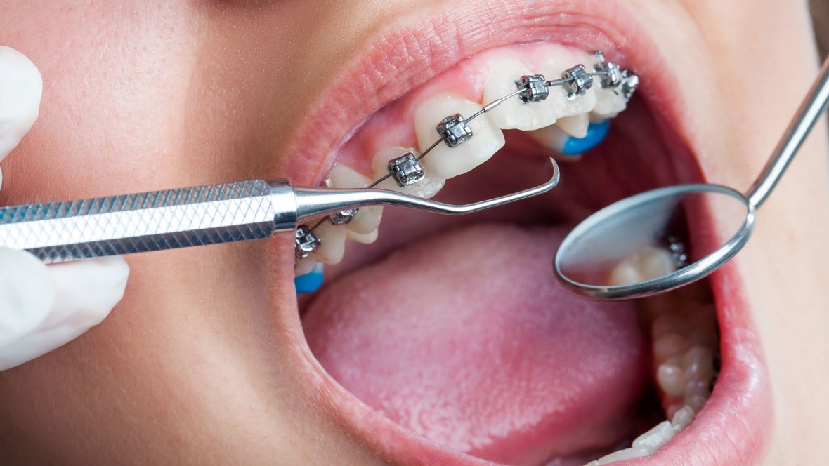 مراجعه به دندانپزشک عمومی در طول ارتودنسی