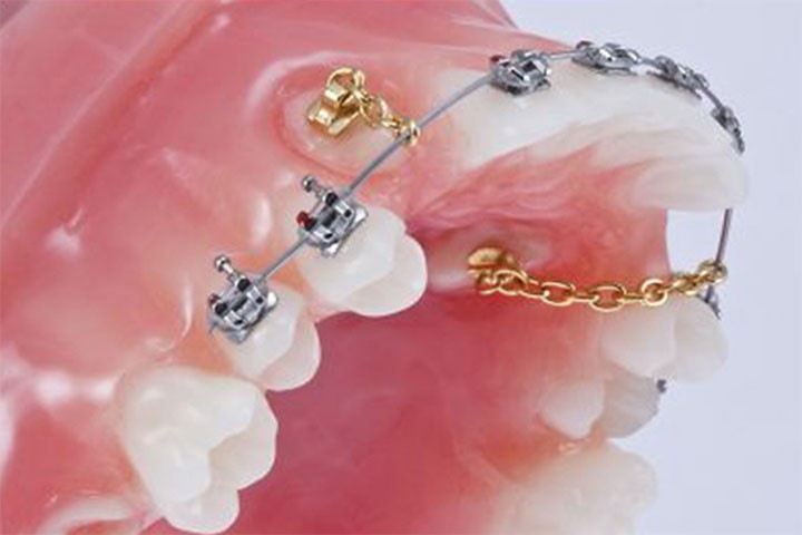 درمان دندان نهفته با ارتودنسی