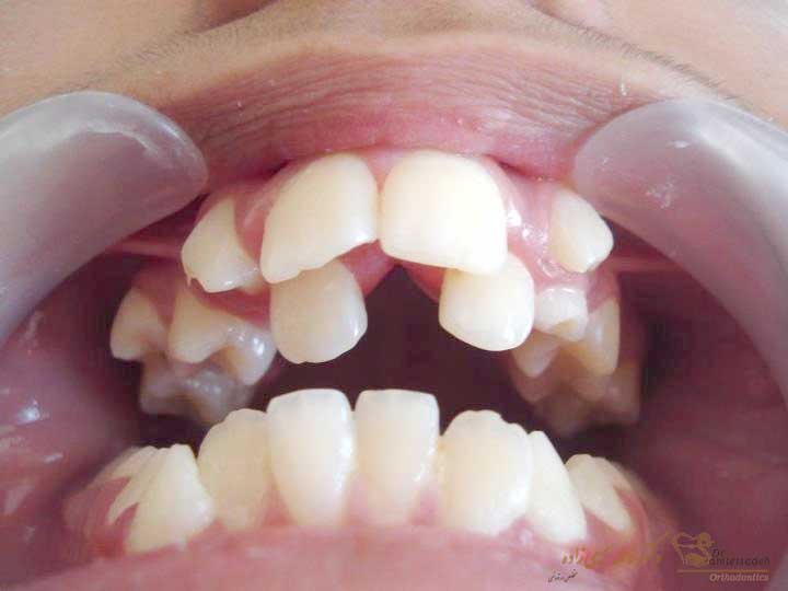ازدحام یا شلوغی دندانی چیست؟